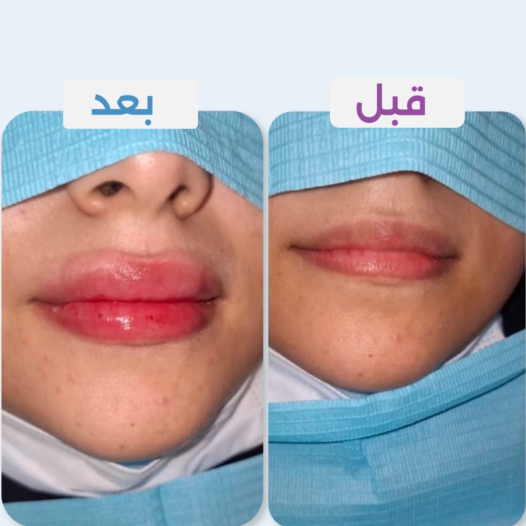فيلر شفايف