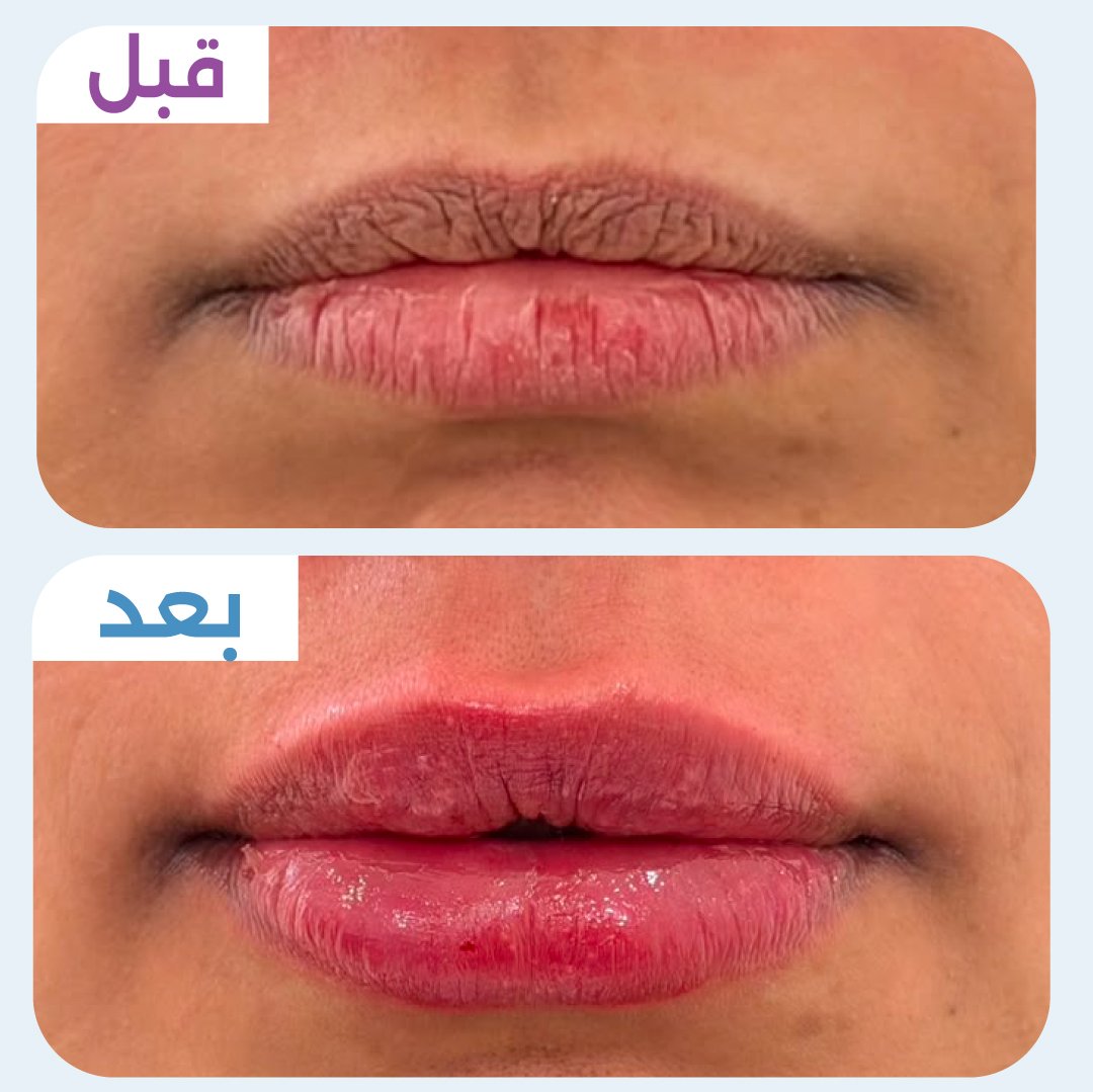 فيلر شفايف