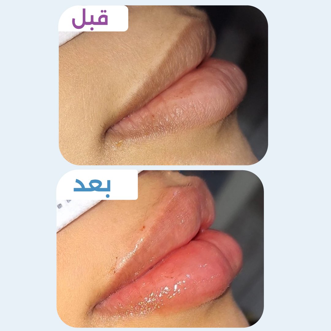 فيلر شفايف