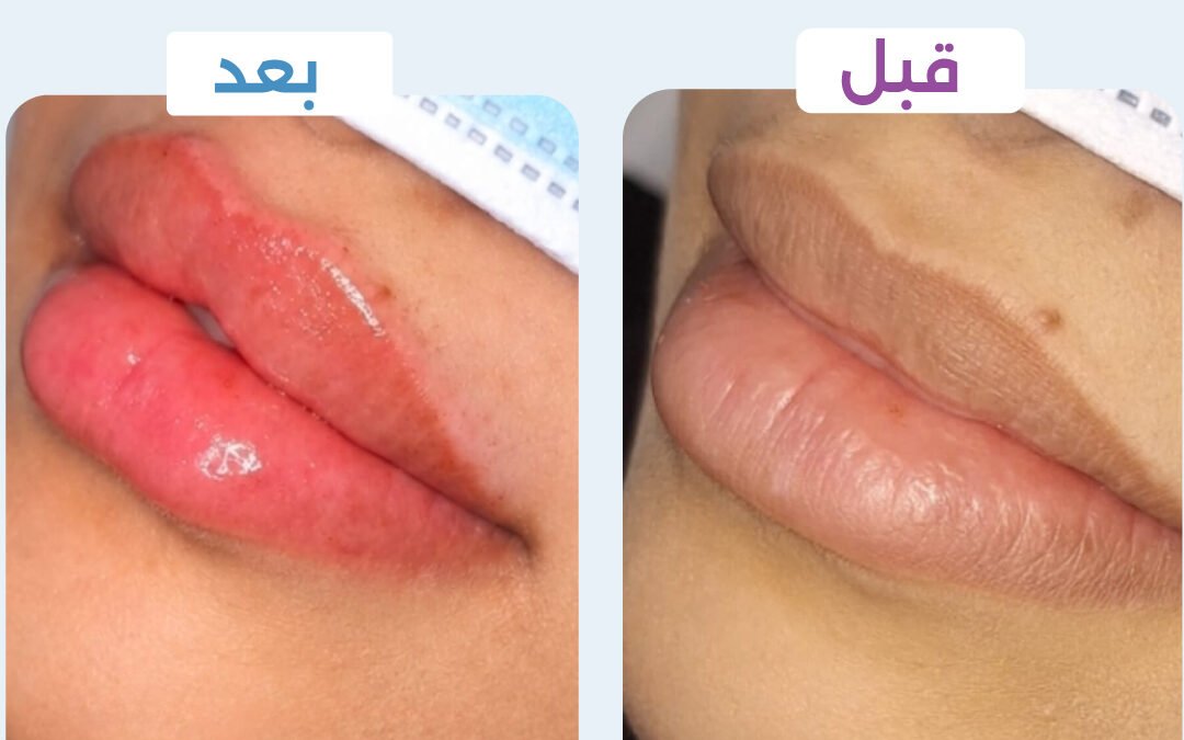 فيلر شفايف