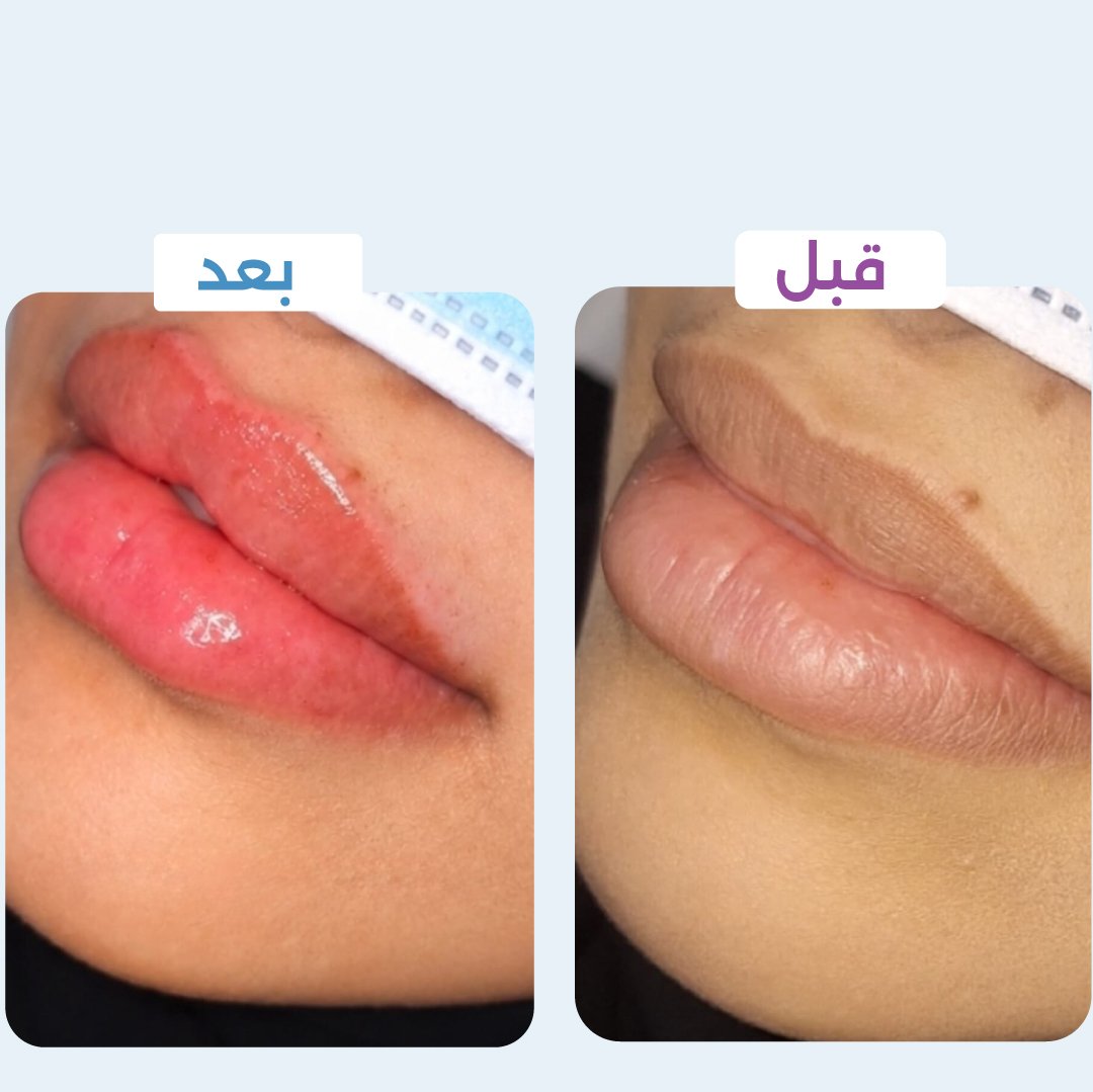 فيلر شفايف